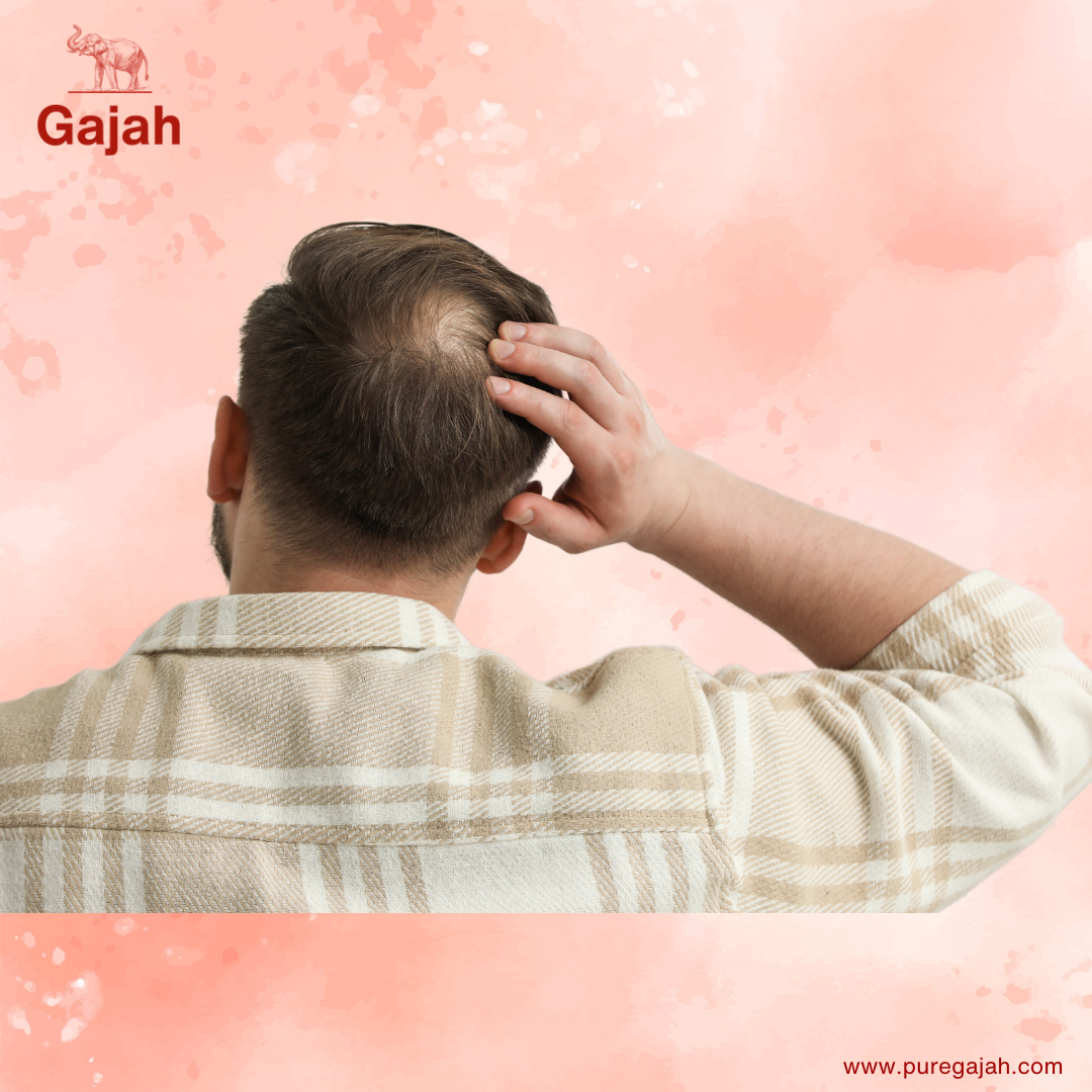 Male Pattern Baldness: Understanding the Signs and Taking Action