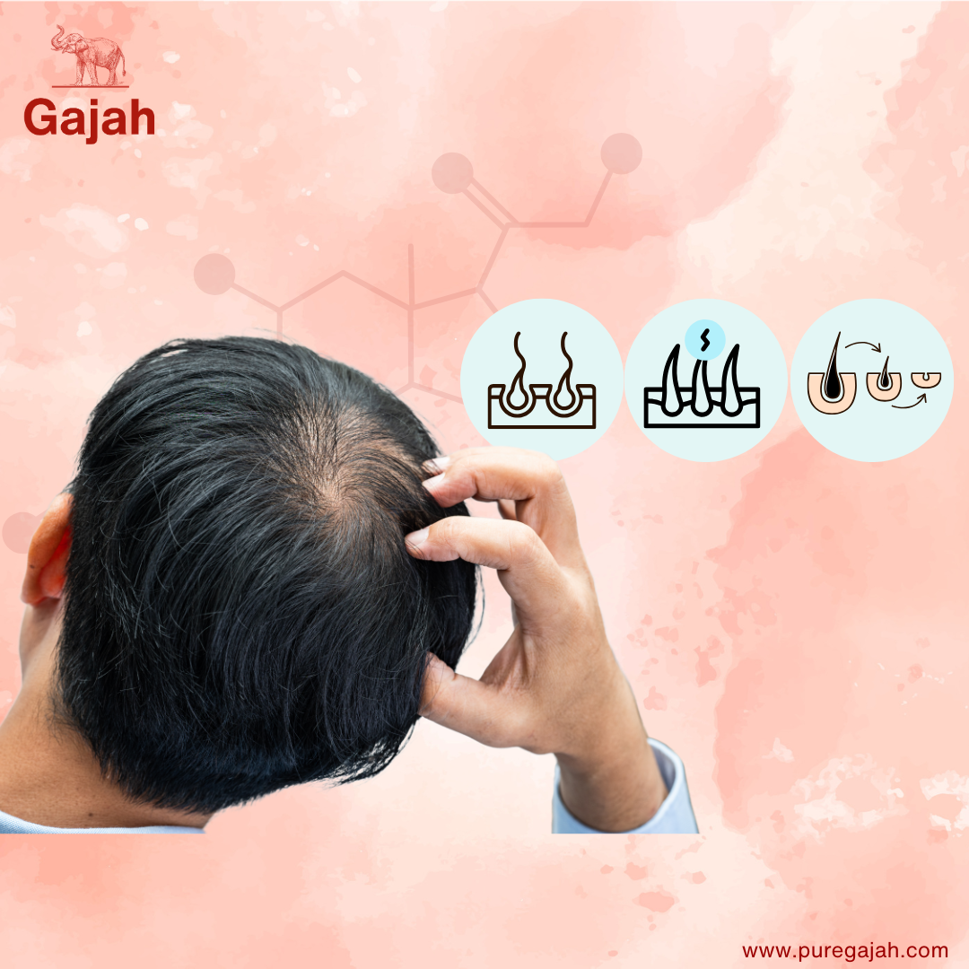 Understanding Dandruff: Causes, Types, and How to Treat It Naturally with Gajah Hair Tonic